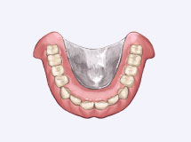 金属床義歯