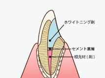 ウォーキングブリーチ