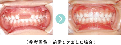 （参考画像：前歯をケガした場合）