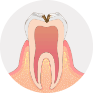 虫歯が神経に近くなり、冷たいものがしみます
